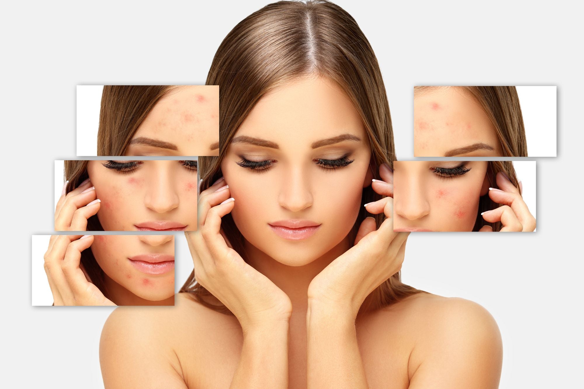 A woman touching her face where she has acne on her temples.