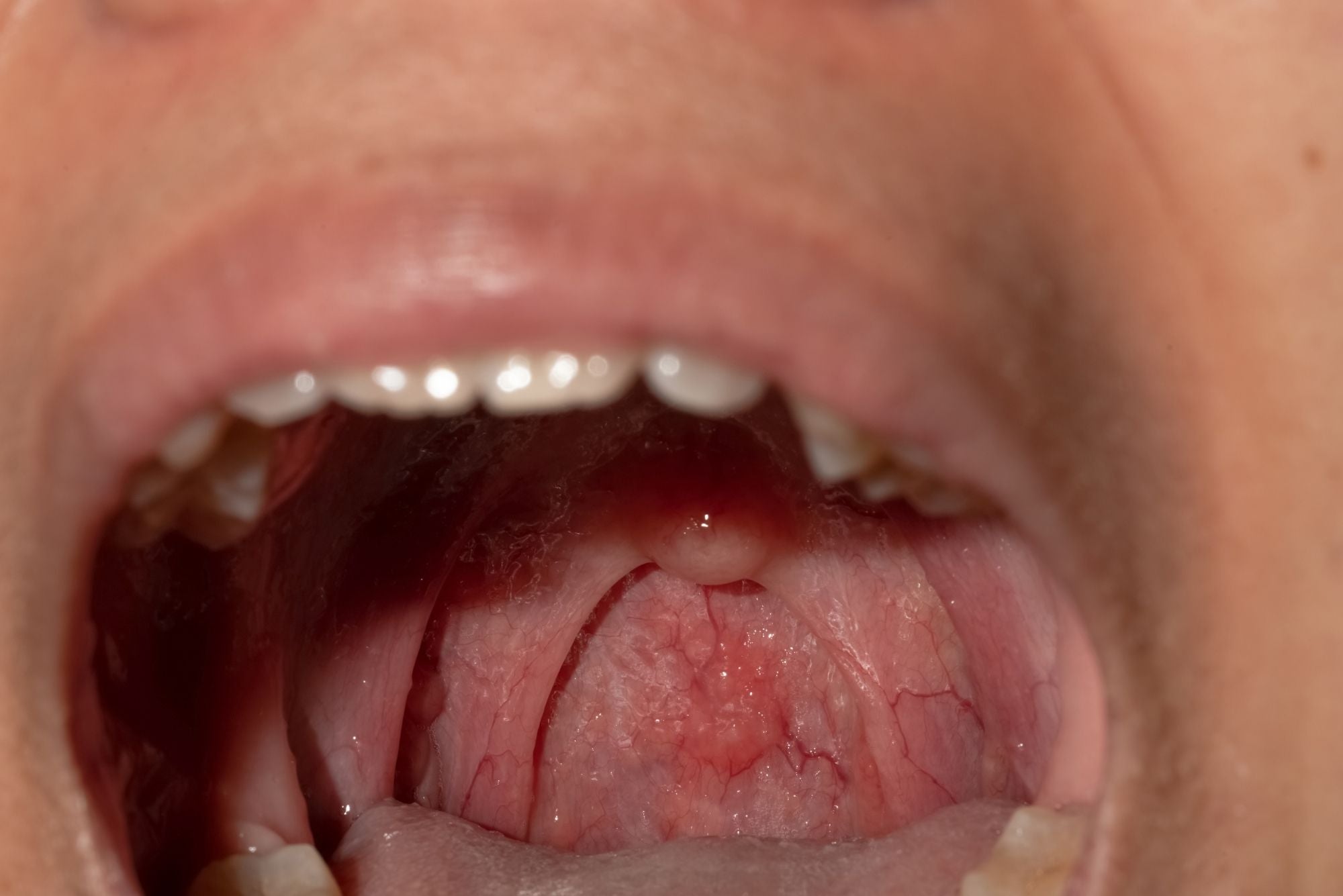 A person with their mouth open shows a canker sore on the uvula.