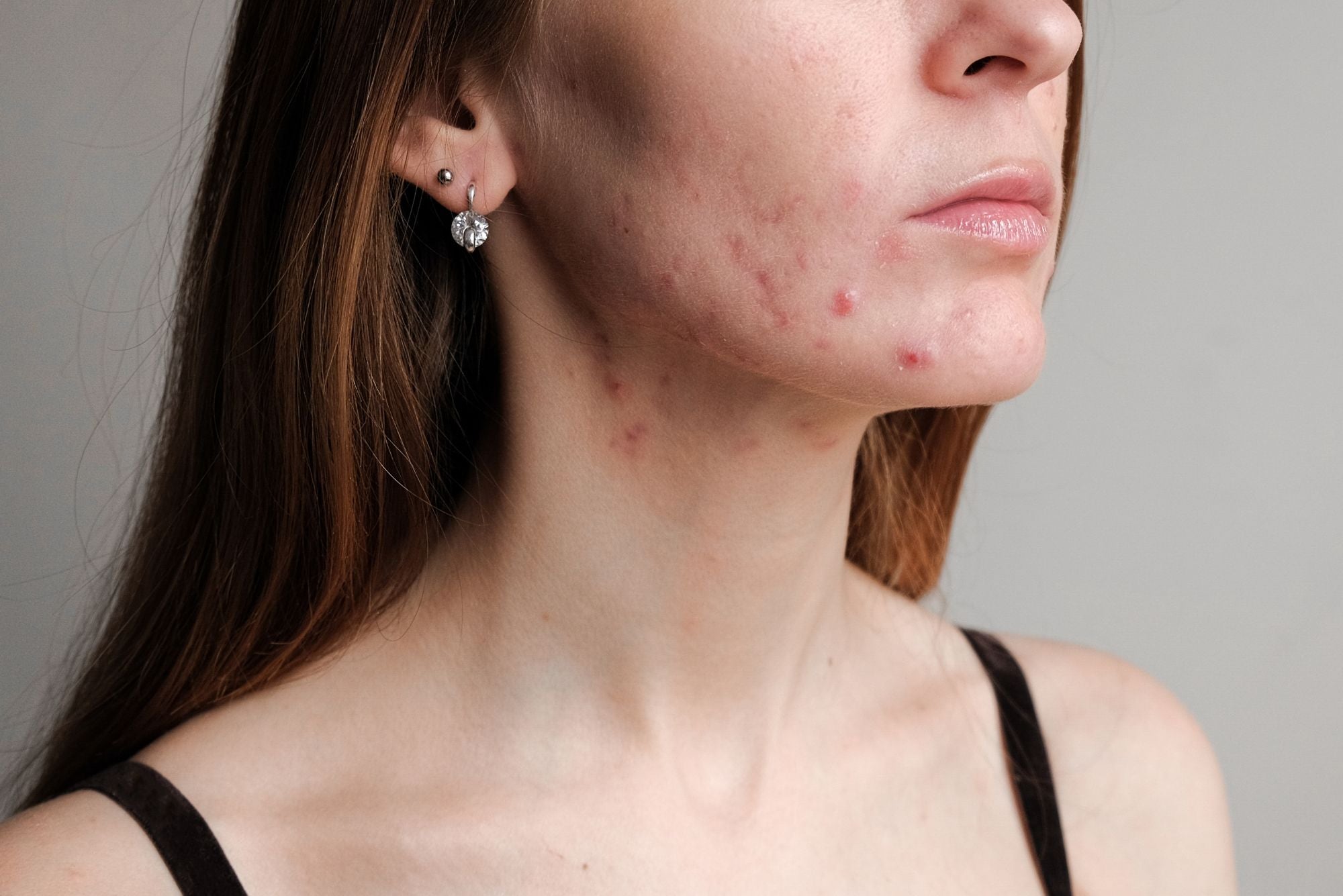 A woman with acne stands still, wondering, does nicotine cause acne?