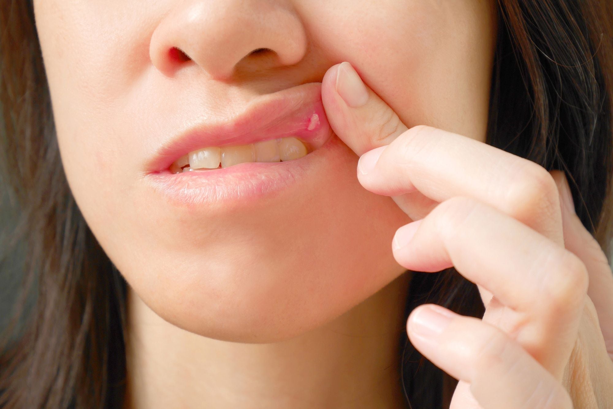 A woman lifts her top lip to look at her infected canker sore.