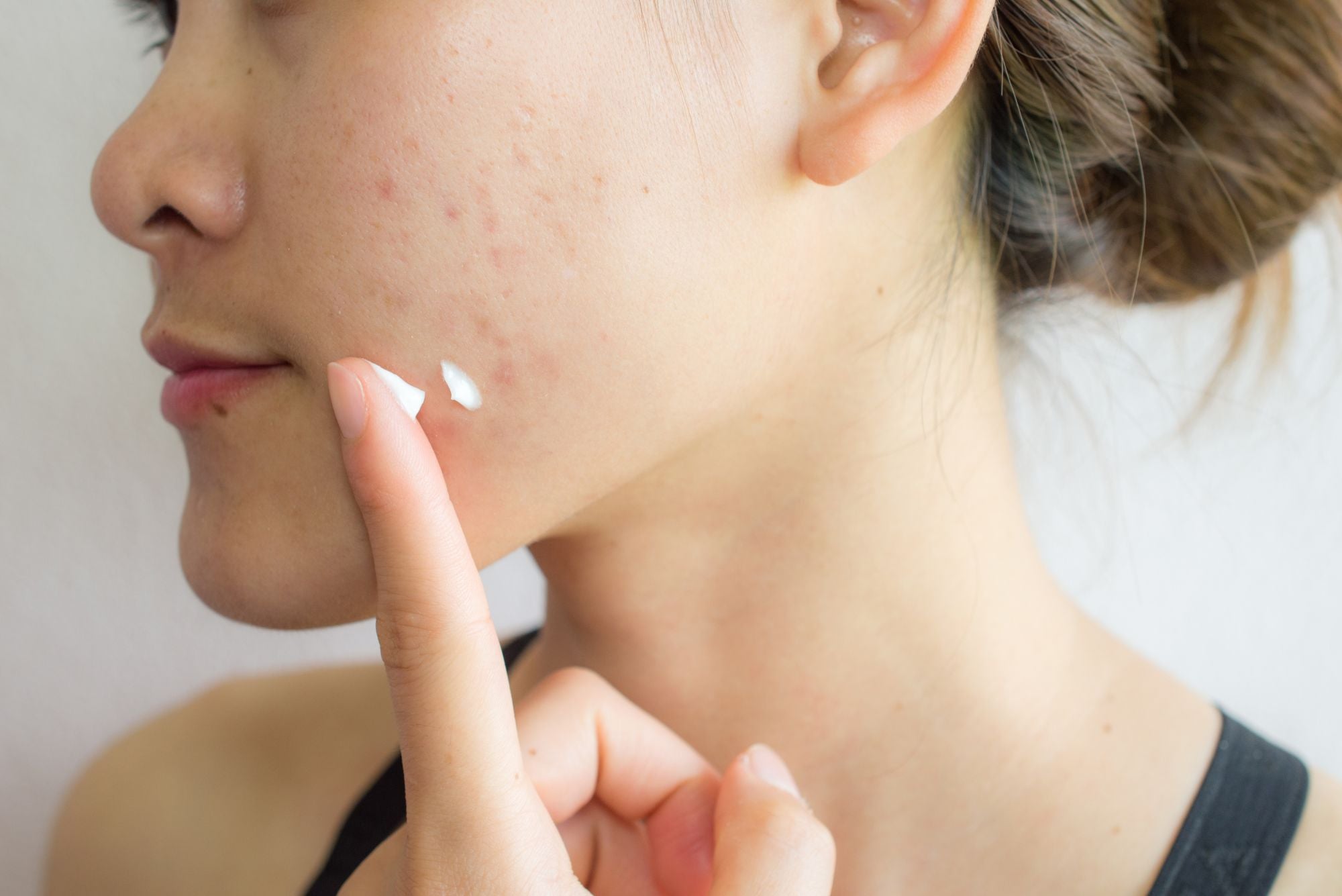 A woman applies hydrocortisone cream to her acne and scars because she wants to know, “Does hydrocortisone help acne scars?”