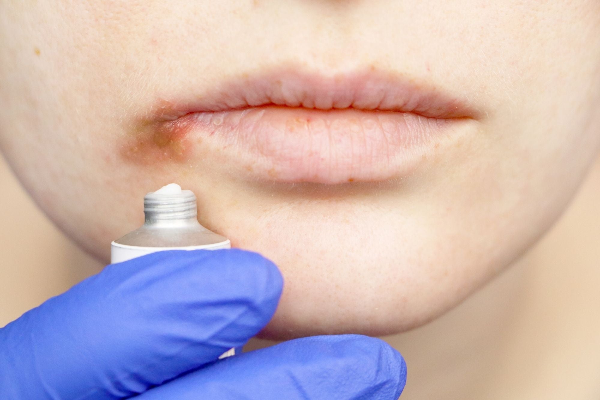 A close-up of a cold sore on someone's lip while a blue-gloved hand applies an Abreva alternative.