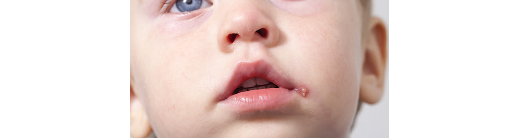 Child with Cold Sore