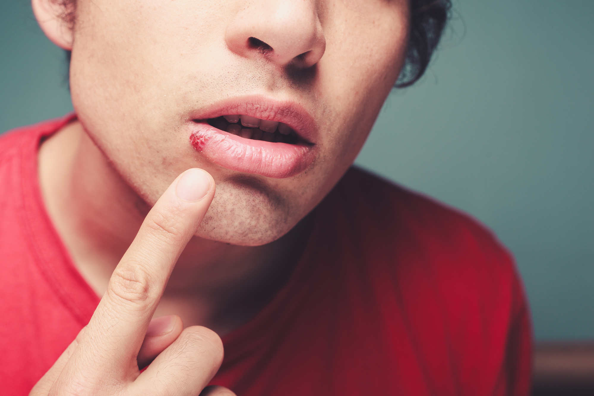 A man in a red shirt inspects a cold sore on his lip while suffering from swollen lymph nodes in his neck.