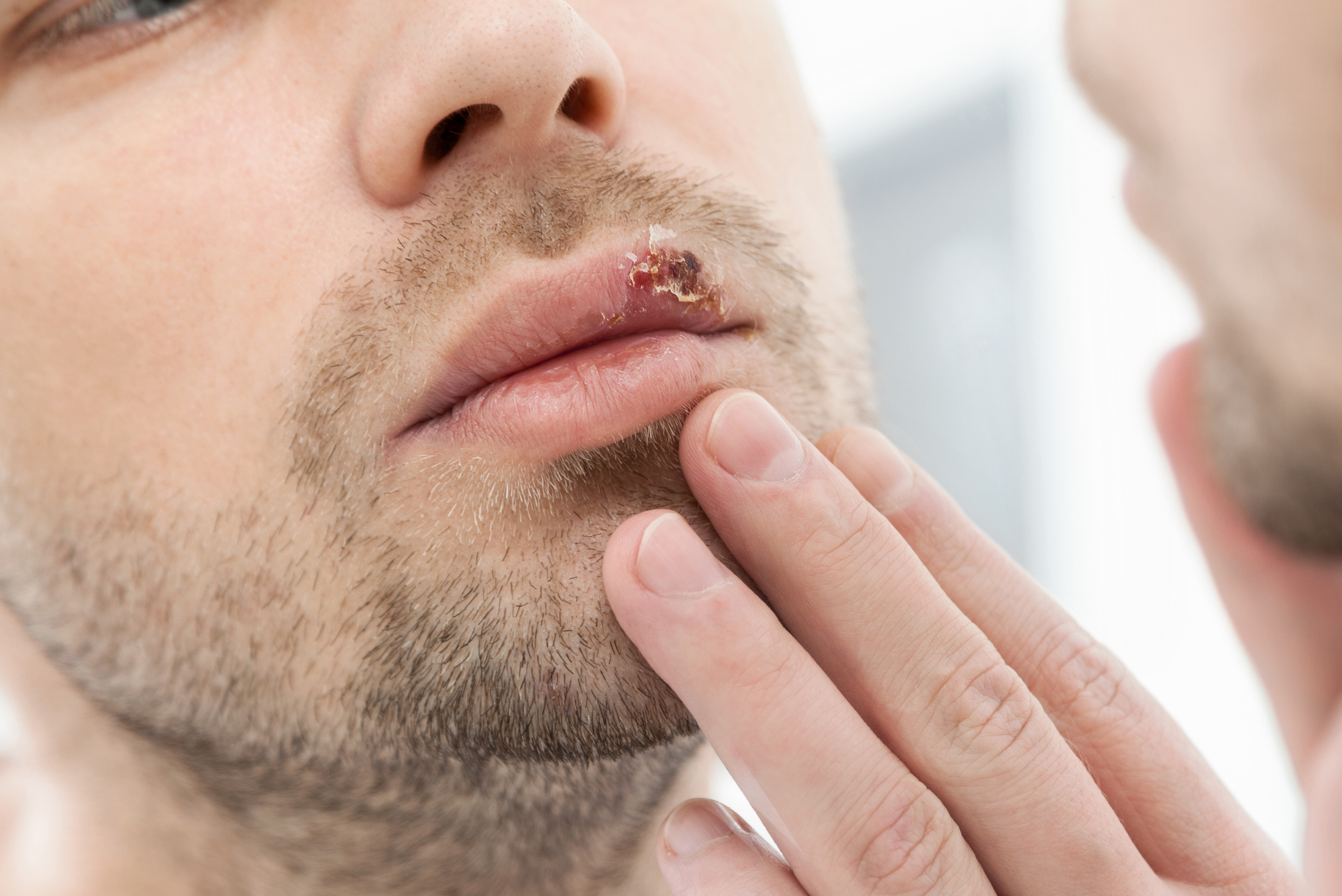 A man looks at a cold sore on his lip, curious about how to stop viral shedding naturally.