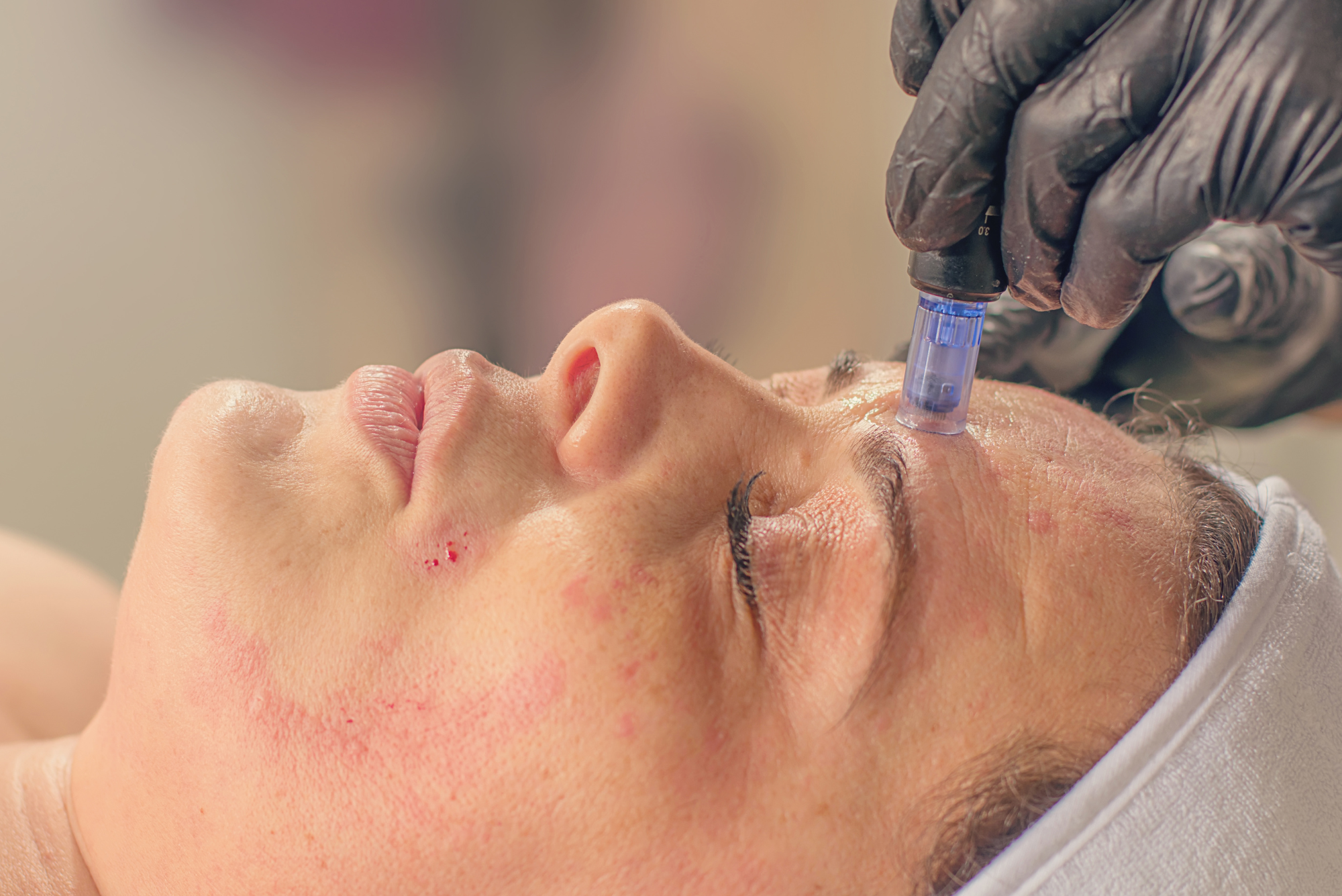 A woman lies on her back while receiving microneedling for her acne scars.