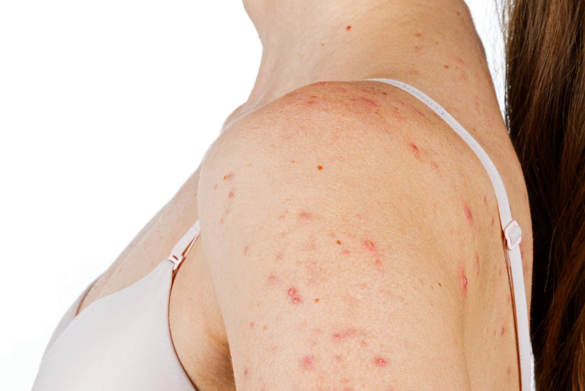 A closeup profile of a woman’s shoulder, showing her severe shoulder acne.