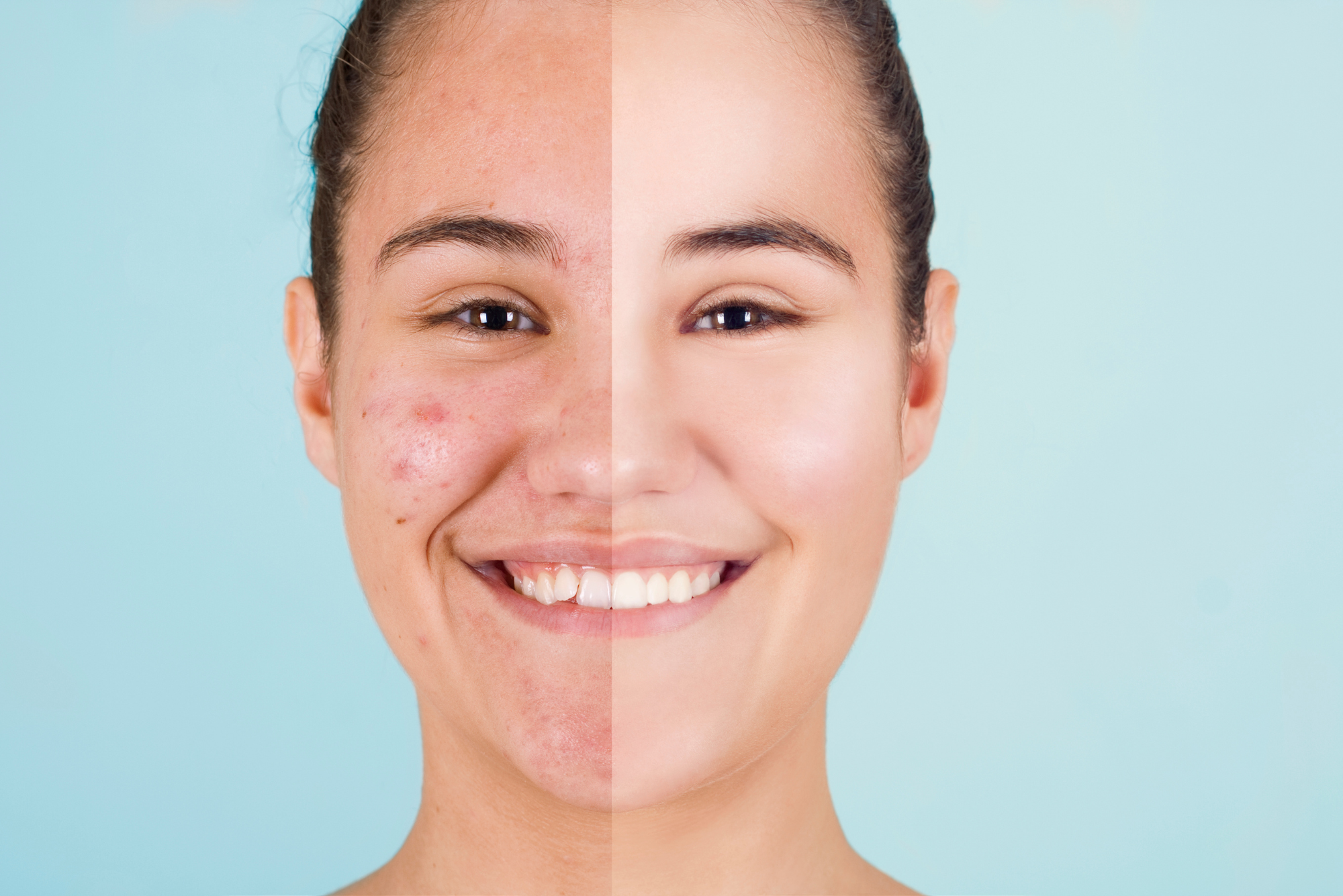 A split view of a woman’s face shows she discovered what kills acne bacteria and used it to treat her breakout.